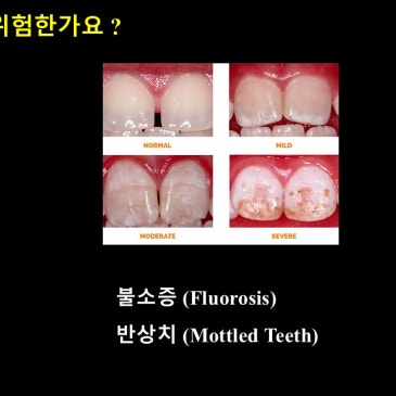 불소, 정말 위험한 성분일까? ③ — 불소증(반상치)